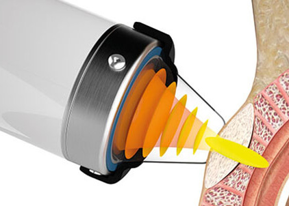 UroPartners Offers APWT
